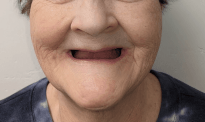 Case 3 before — facial profile with dentures