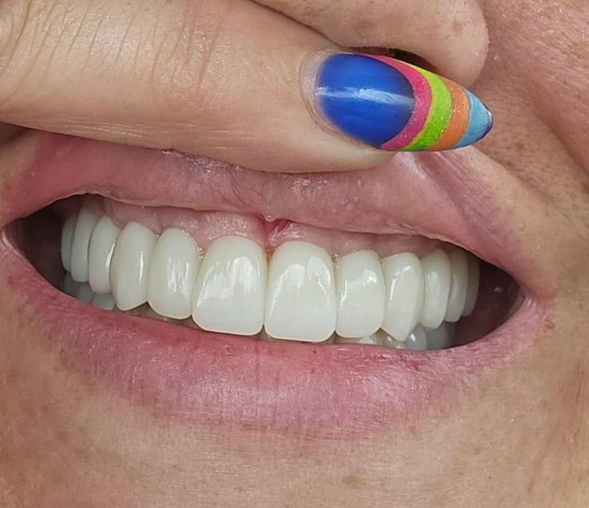 Case 1 after — FP1 upper arch restoration