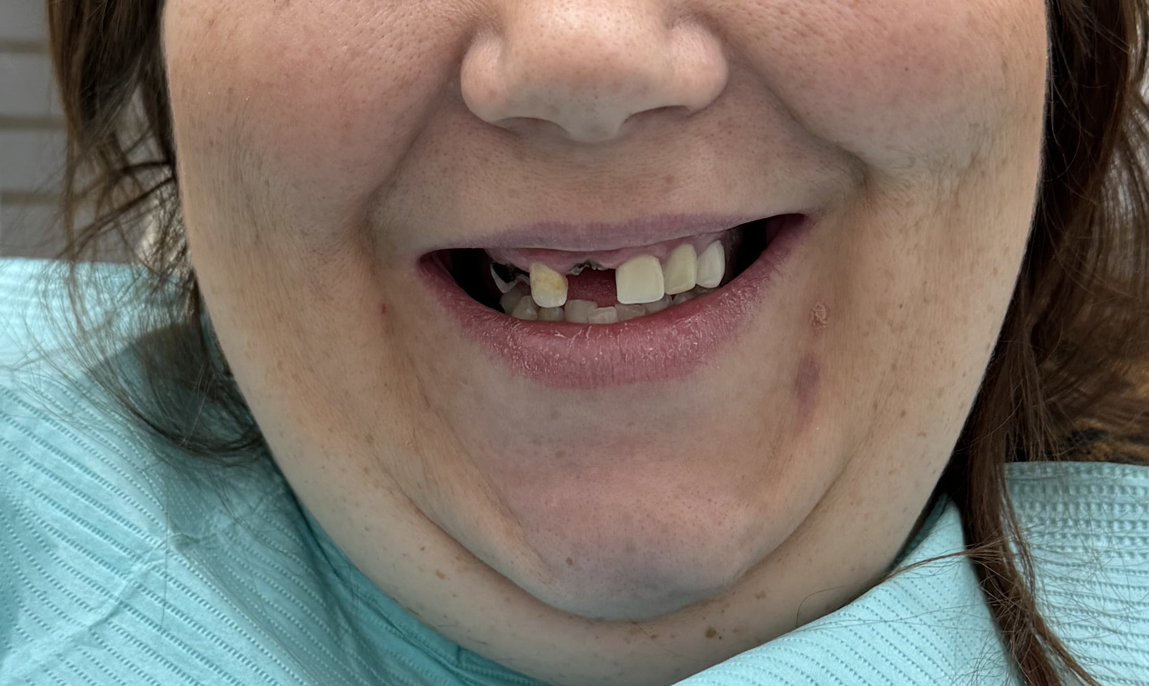 Case 1 before — upper arch pre-treatment