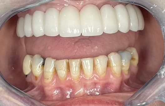 Case 2 additional after — FP2 upper arch result