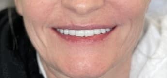 Case 2 after — FP2 upper arch restoration