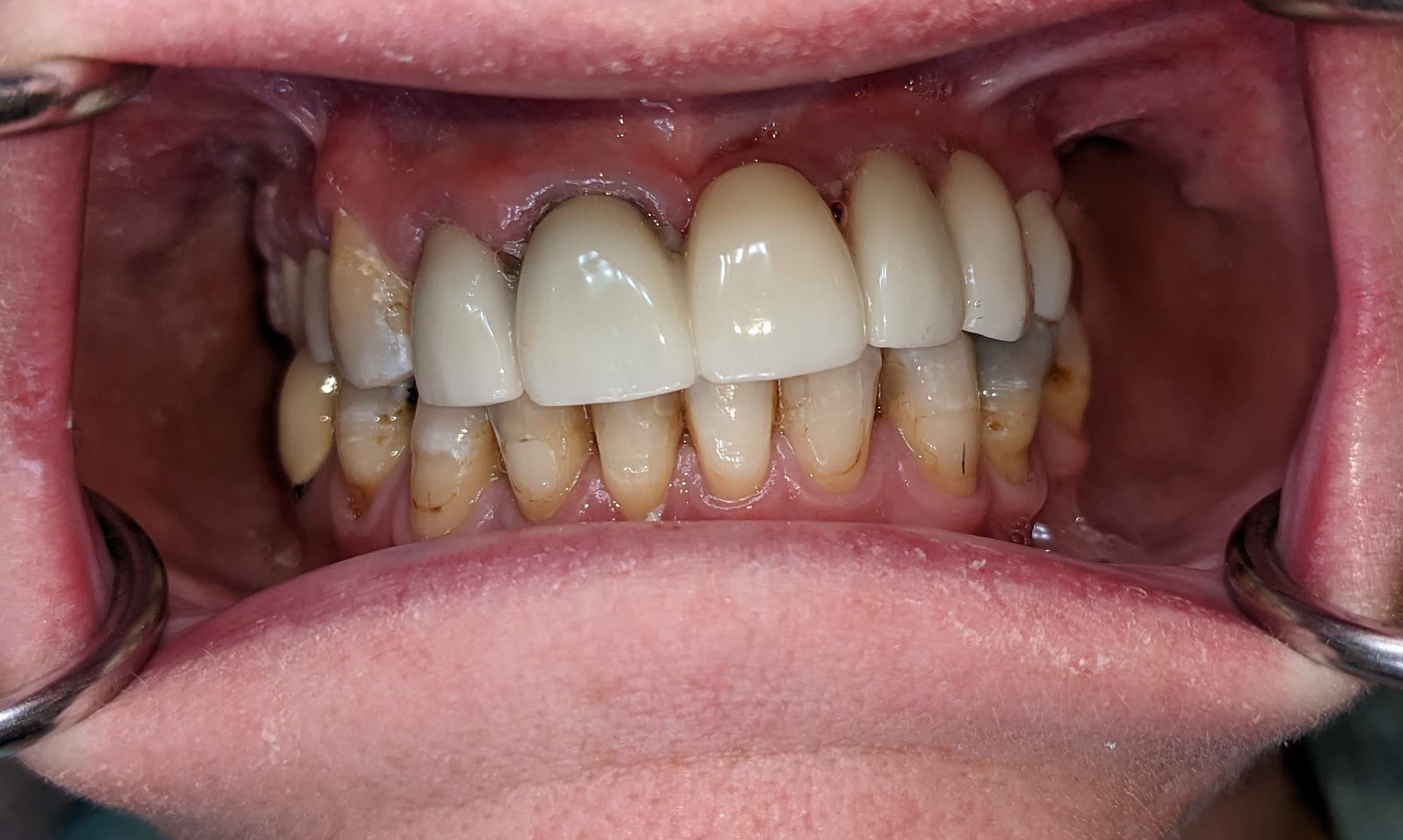 Case 2 before — upper arch pre-treatment