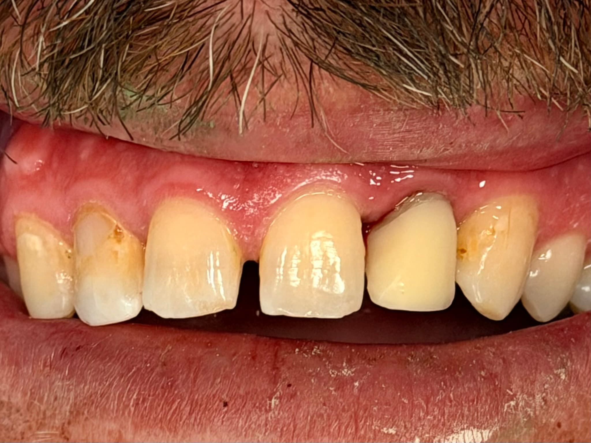 Case 4 after — immediate temporary crown placed same day