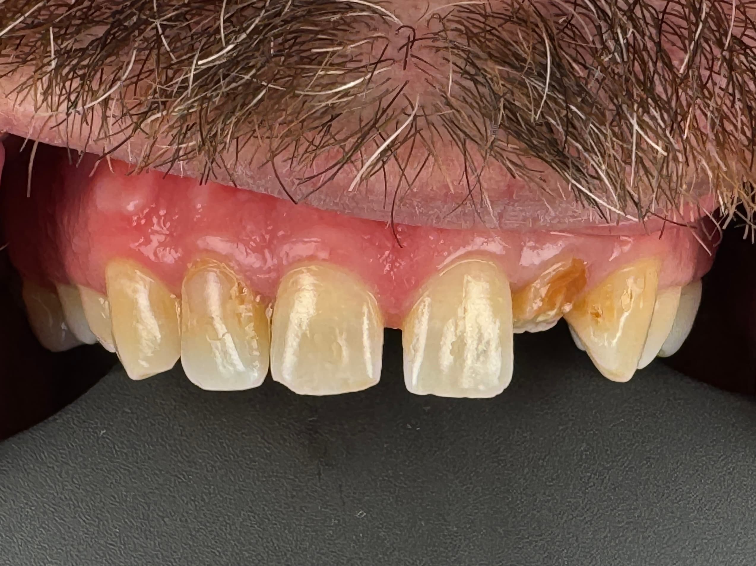Case 4 before — missing lateral incisor