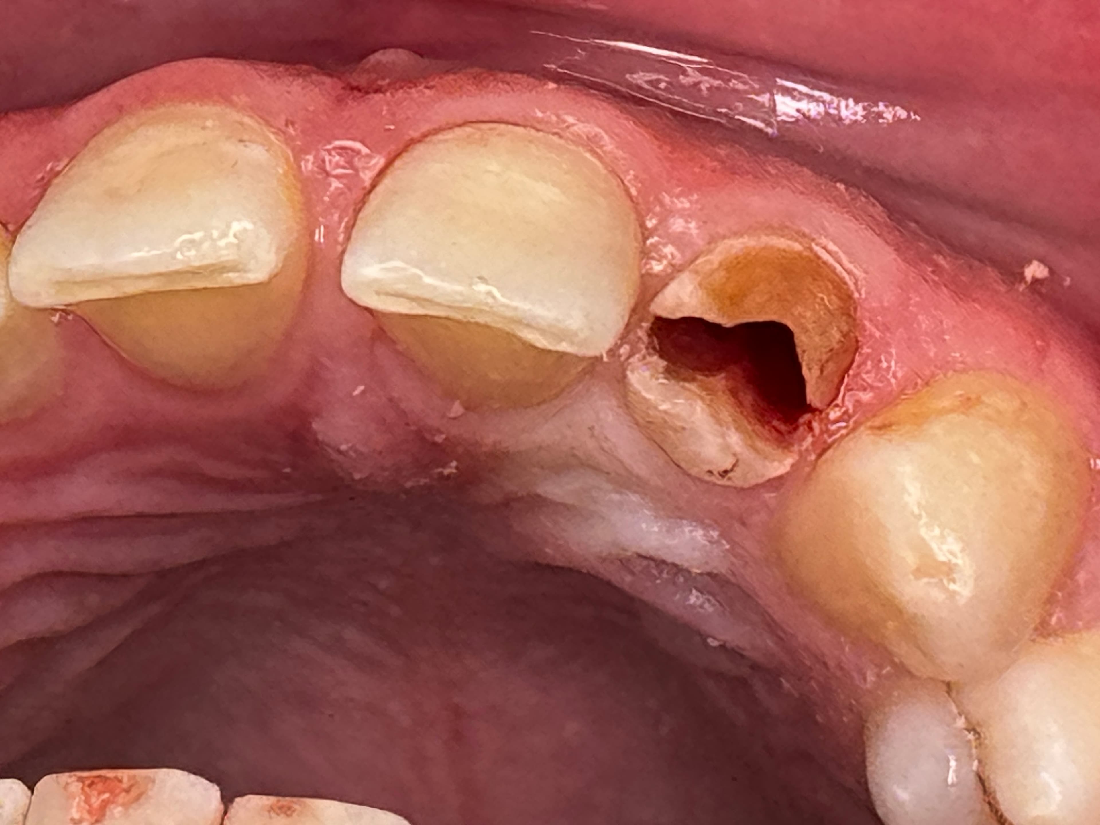 Case 4 procedure — pre-treatment lower anterior