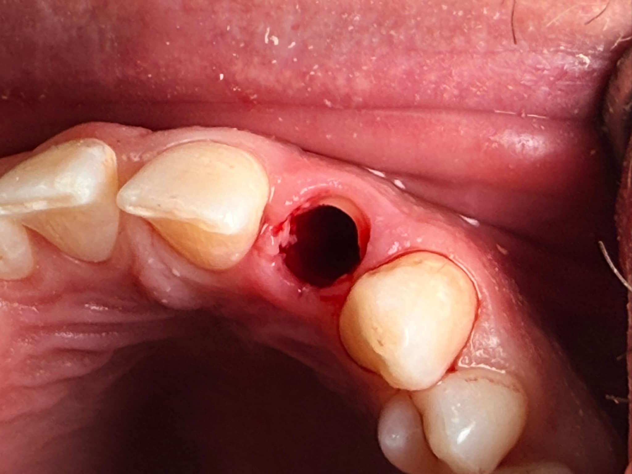 Case 4 procedure — the socket shield