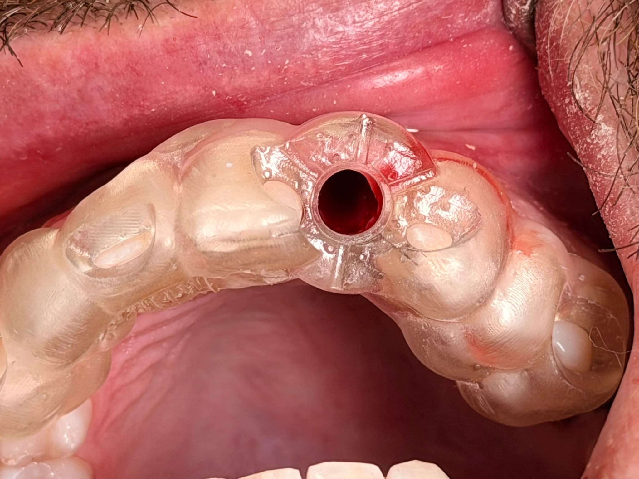 Case 4 procedure — surgical guide seated