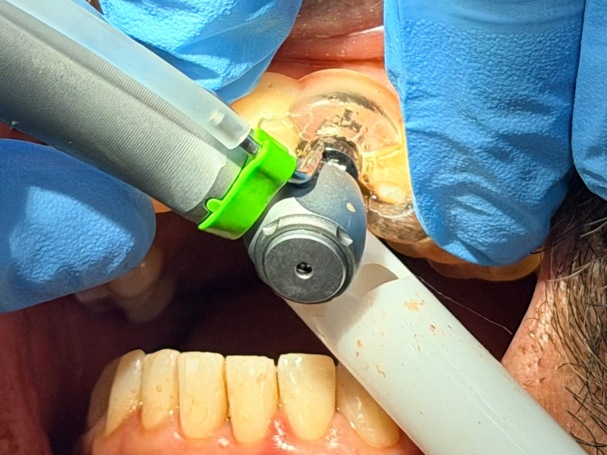 Case 4 procedure — placement through surgical guide
