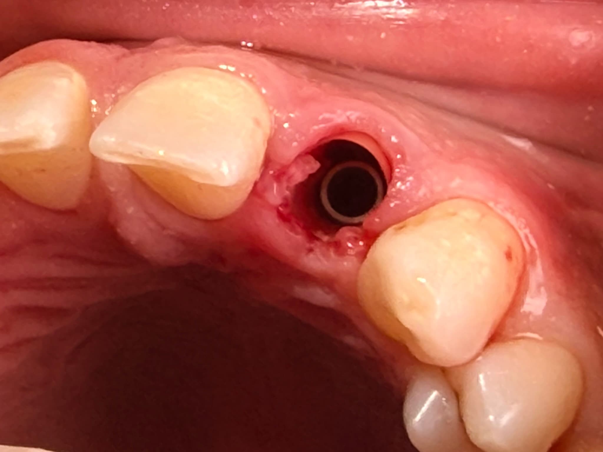 Case 4 procedure — implant perfectly positioned
