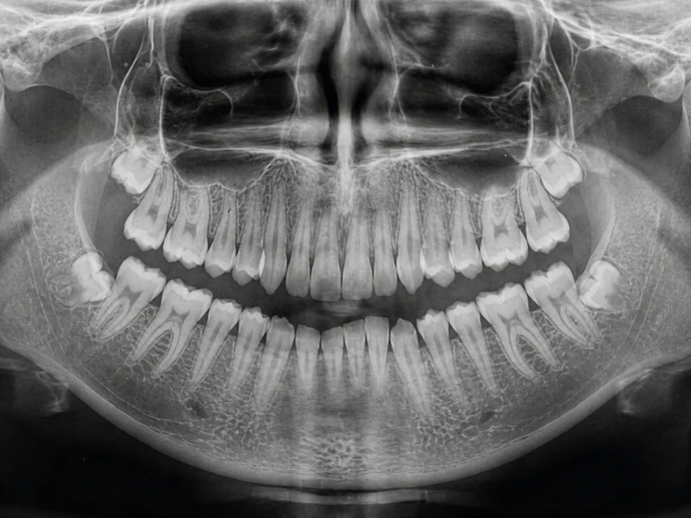 Bone Augmentation