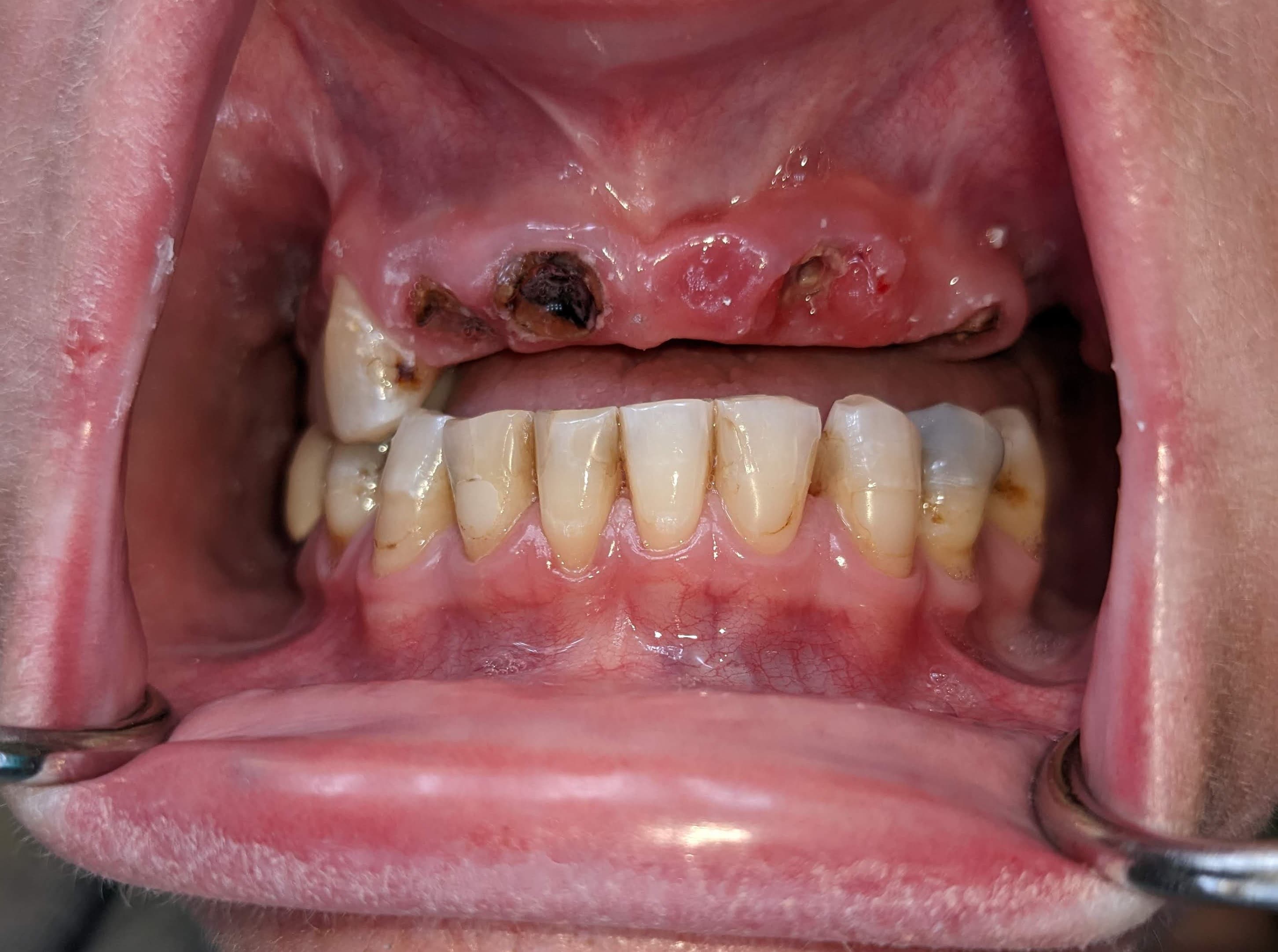 Case 2 additional before — upper arch pre-treatment
