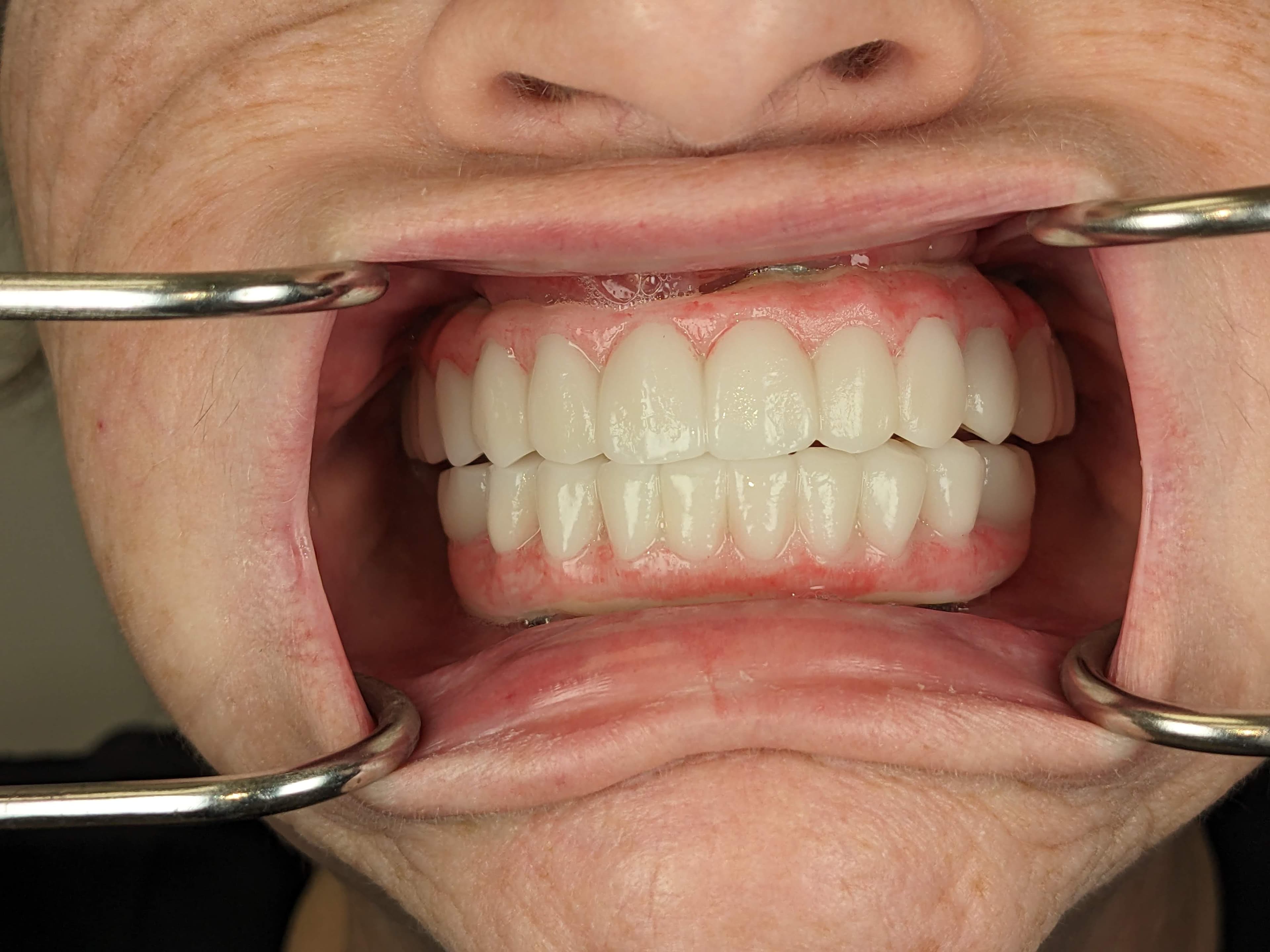 Case 3 after — FP3 smile result