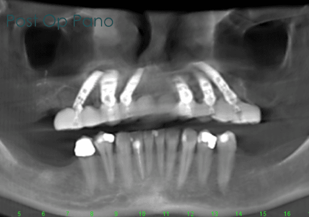 Case 3 post-op panoramic X-ray