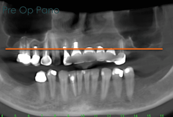 Case 3 pre-op panoramic X-ray
